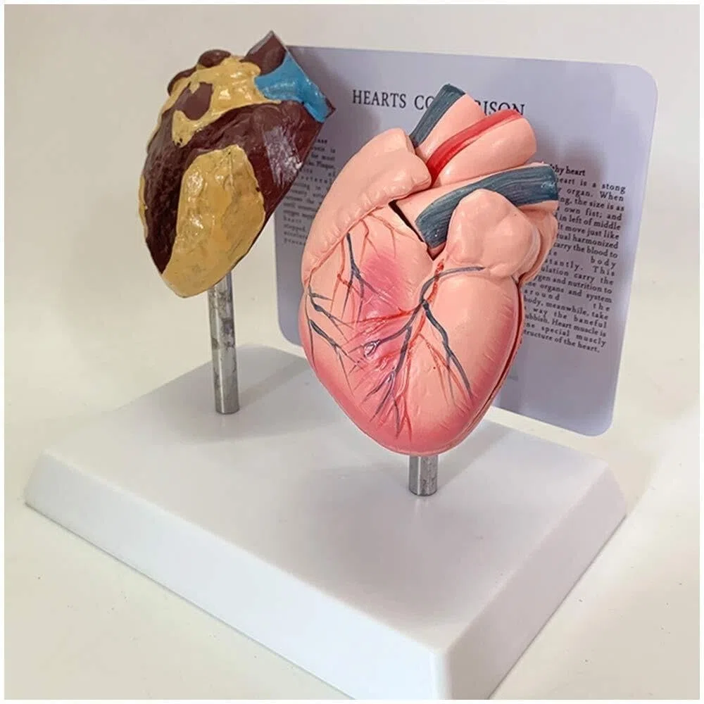 Model anatomiczny patologicznego serca, model porównawczy zdrowego serca i palenia serca, narzędzie do komunikacji lekarza i pacjenta, do prezentacji nauki, nauczania medycznego