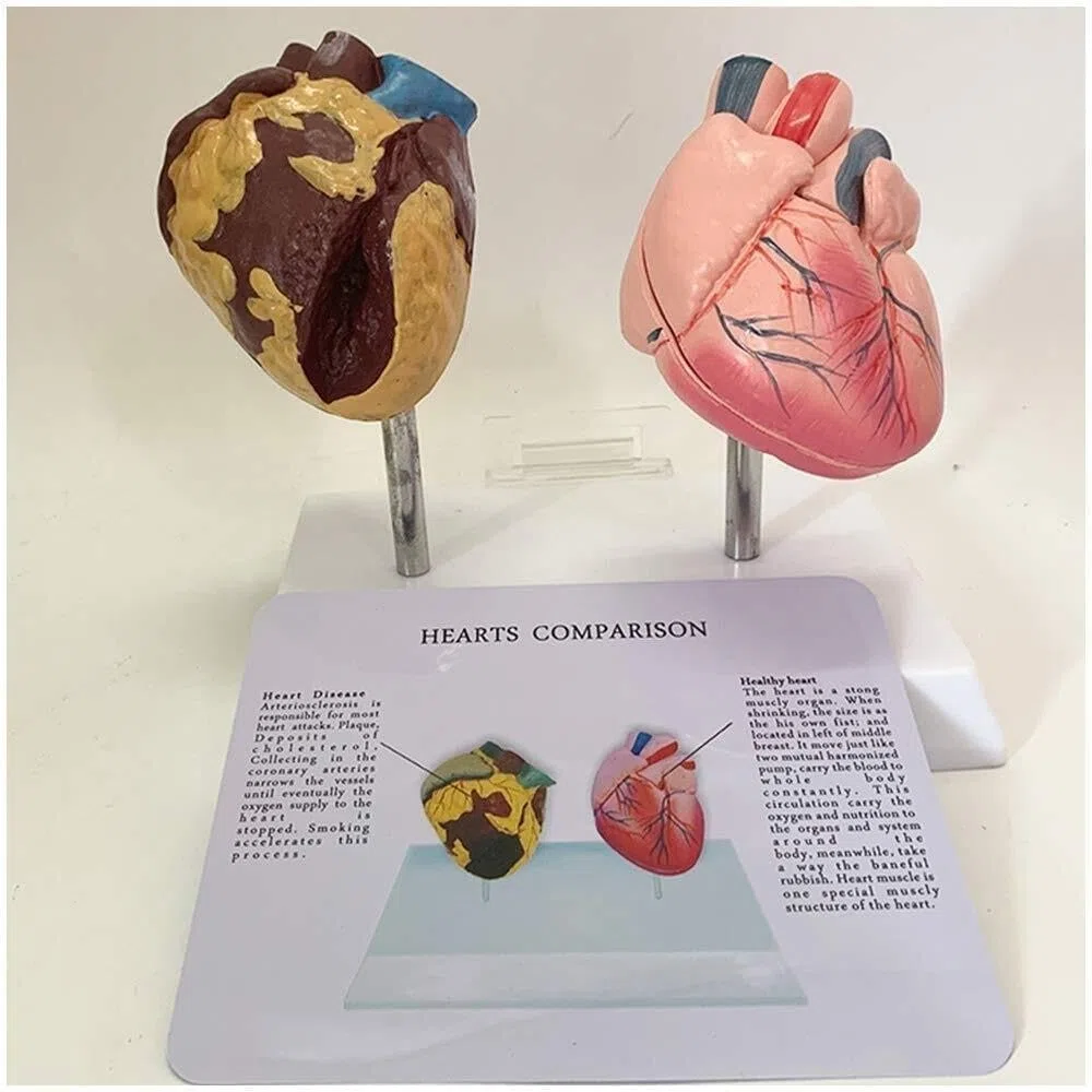 Model anatomiczny patologicznego serca, model porównawczy zdrowego serca i palenia serca, narzędzie do komunikacji lekarza i pacjenta, do prezentacji nauki, nauczania medycznego