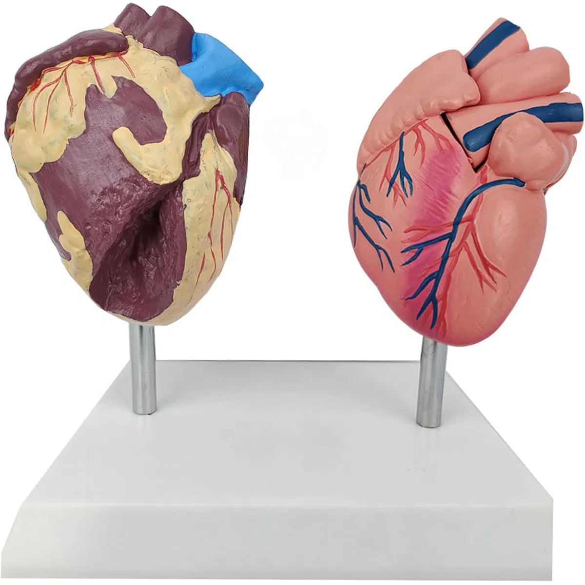 Model anatomiczny patologicznego serca, model porównawczy zdrowego serca i palenia serca, narzędzie do komunikacji lekarza i pacjenta, do prezentacji nauki, nauczania medycznego